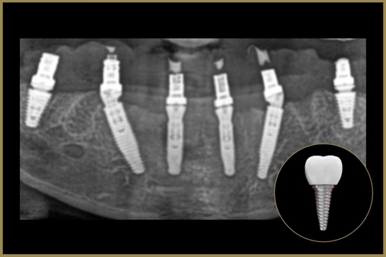 Dental Implant