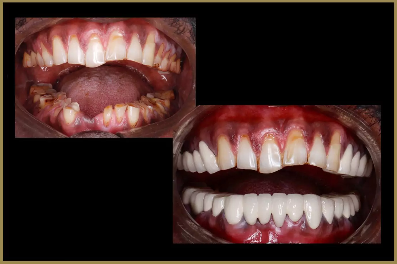 full-mouth-rehabilation